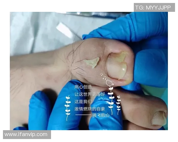 足球明星因甲沟炎困扰赛季表现专家解析病因与康复之道 足球明星因甲沟炎困扰赛季表现专家解析病因与康复之道